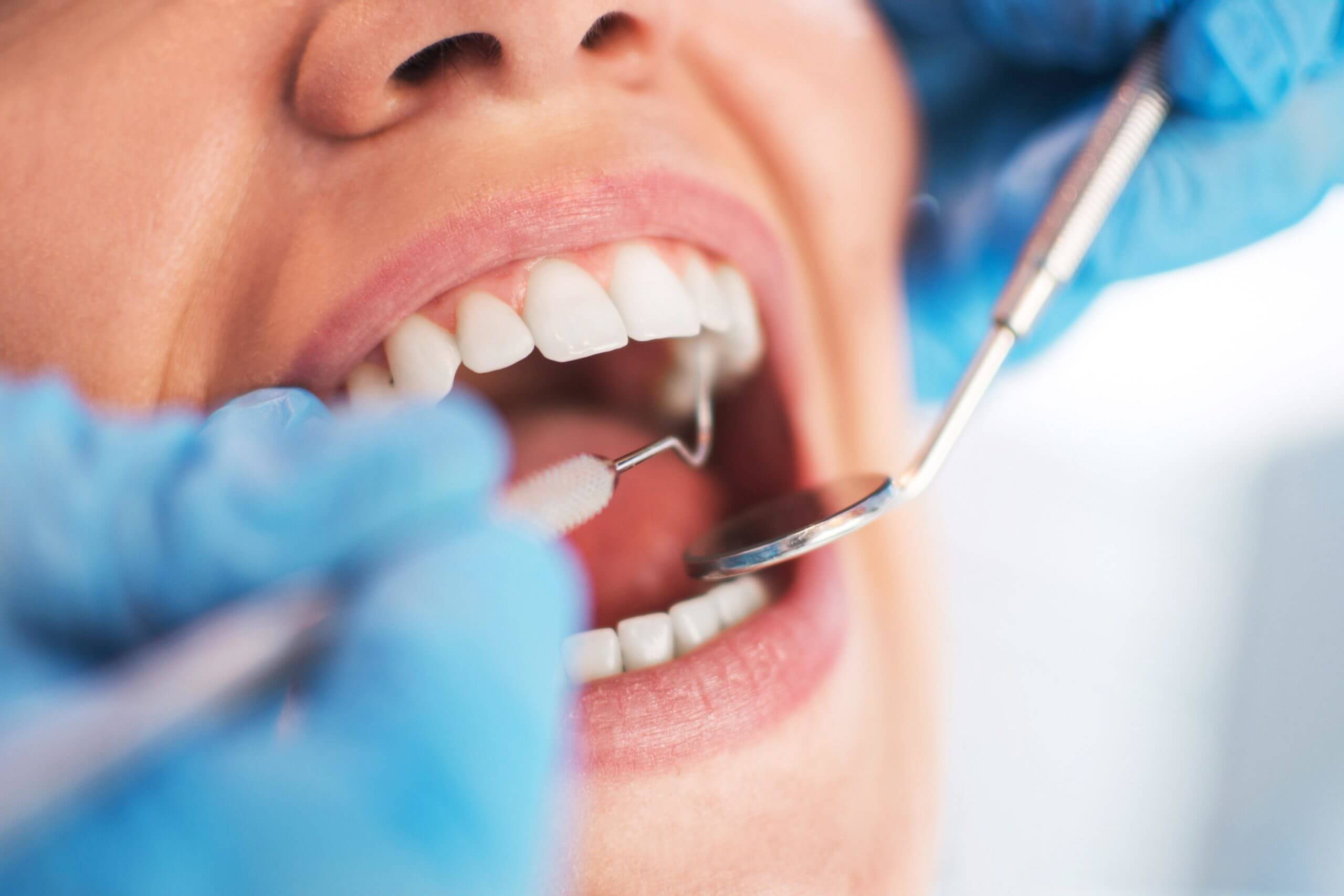 Dental cleaning in Thousand Oaks, Ventura
