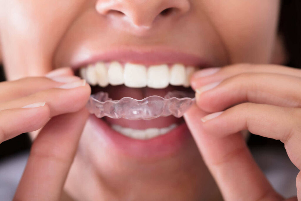 Night guards in Thousand Oaks