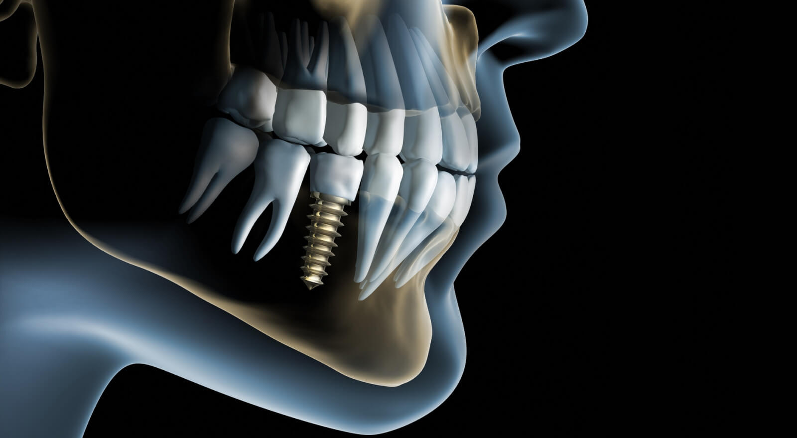 Teeth Implants in Thousand Oaks