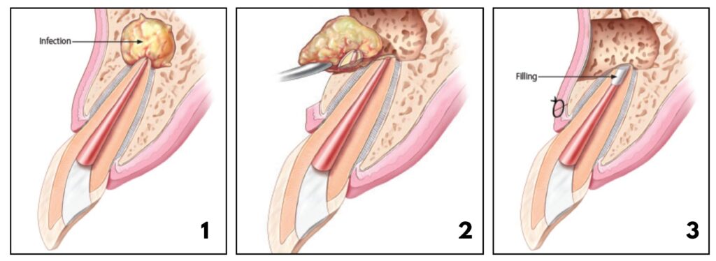 Apicoectomy procedure in California