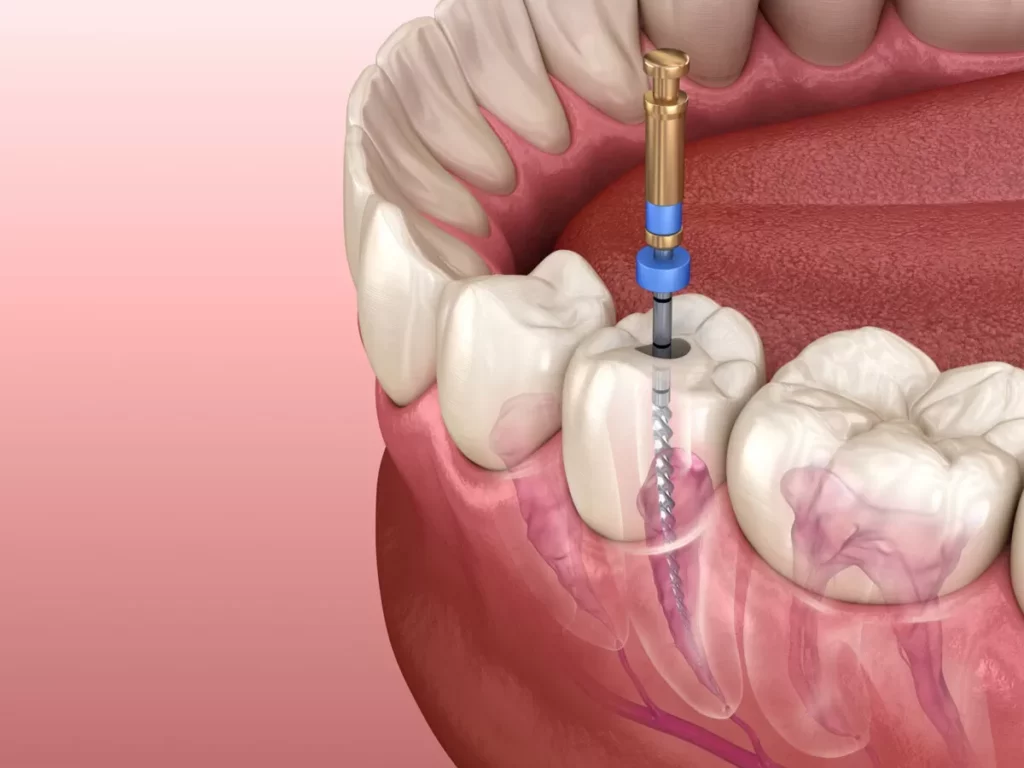 Root canal treatments near me