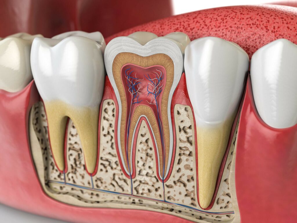 Treatment of root canal in CA