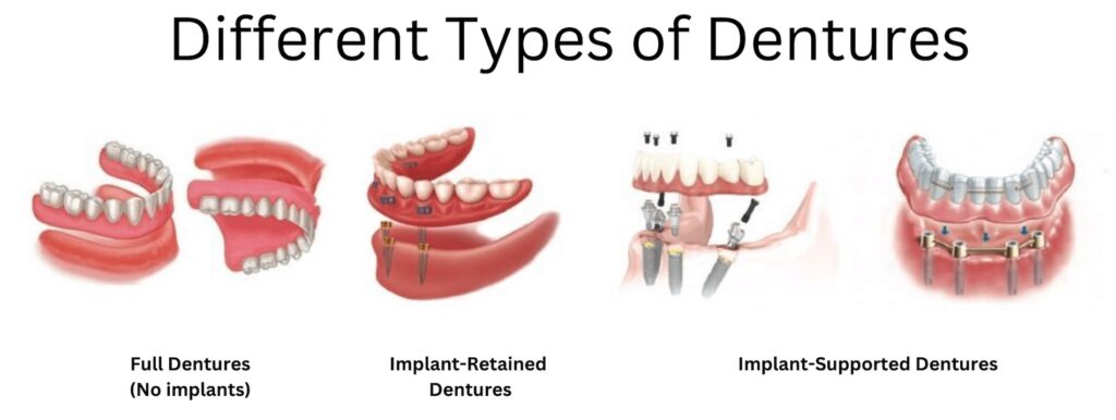 Full, implant-retained, implant-supported, partial dentures.