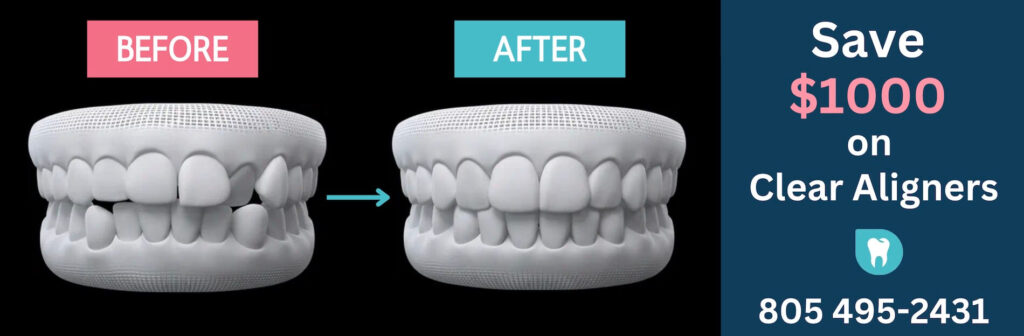 Save $1000 on Clear Aligners