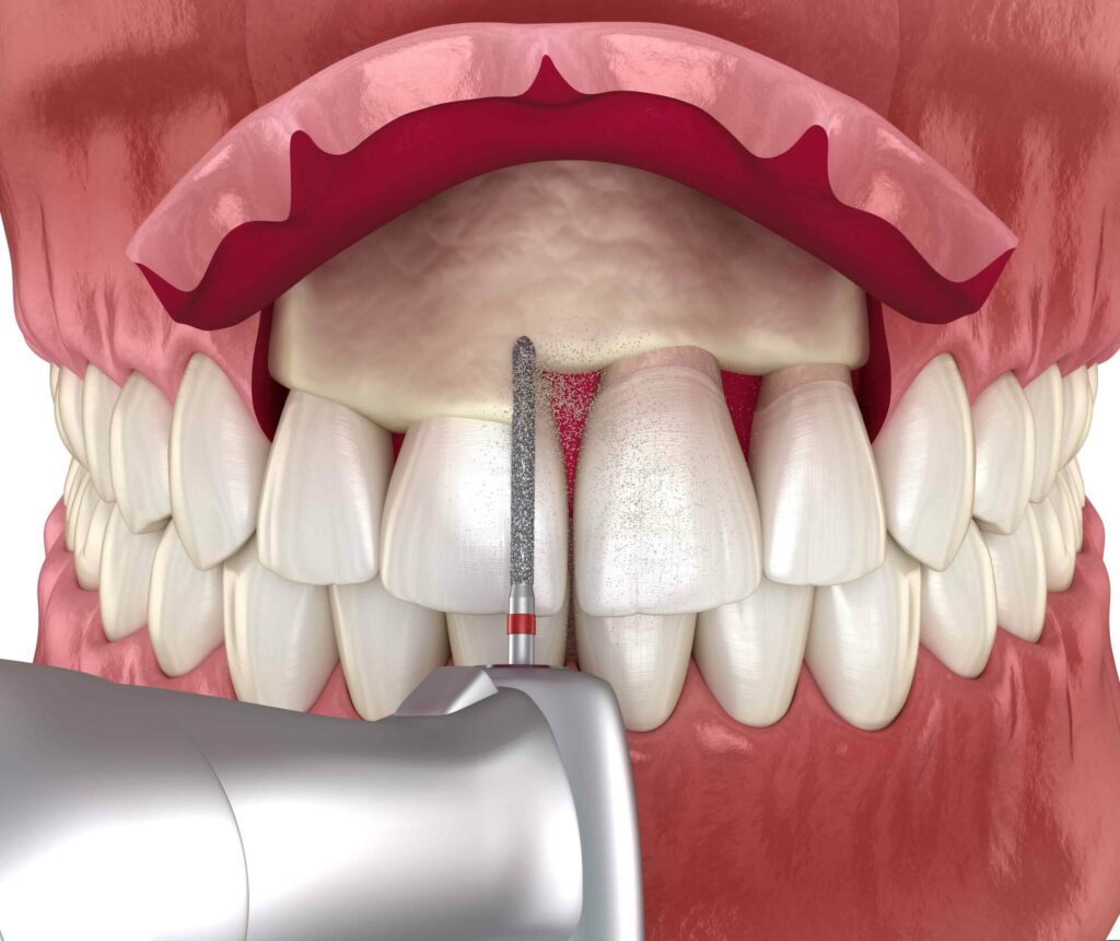 Dental crown lengthening near me