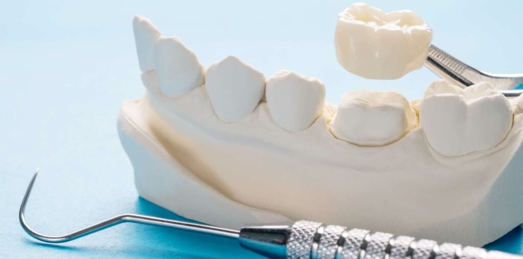 Dental Crowns Thousand Oaks Dental Studio