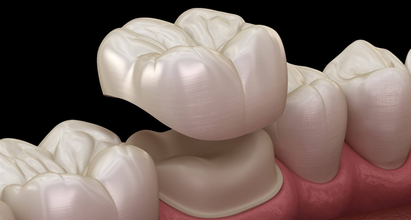 Crown dental procedure in Thousand Oaks