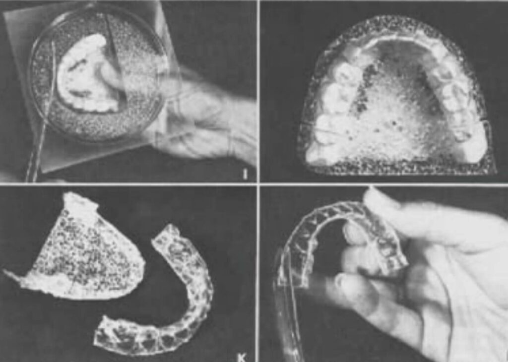1971 Robert John Ponitz Invisible Retainers, showcasing the evolution of orthodontic treatments with clear, custom-fit devices designed for discreet post-treatment alignment maintenance