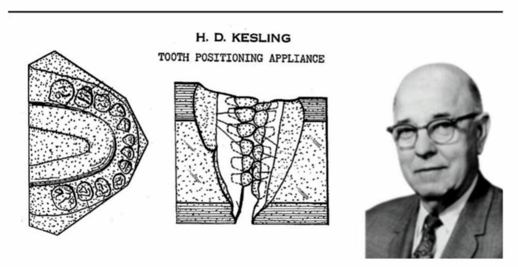 Kesling Tooth Positioner, showcasing the groundbreaking 1945 invention that revolutionized orthodontics with removable appliances for effective teeth alignment and enhanced patient comfort.