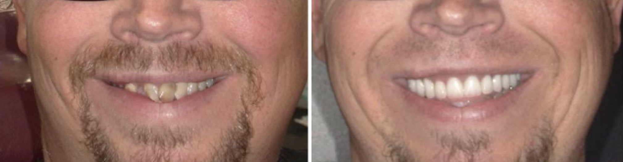 All-on-4 Dental Implants at Lombard Dental Studio in Thousand Oaks