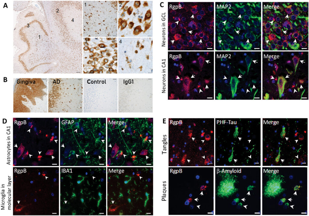 Fig. 2 RgpB colocalizes with neurons and pathology in AD hippocampus.