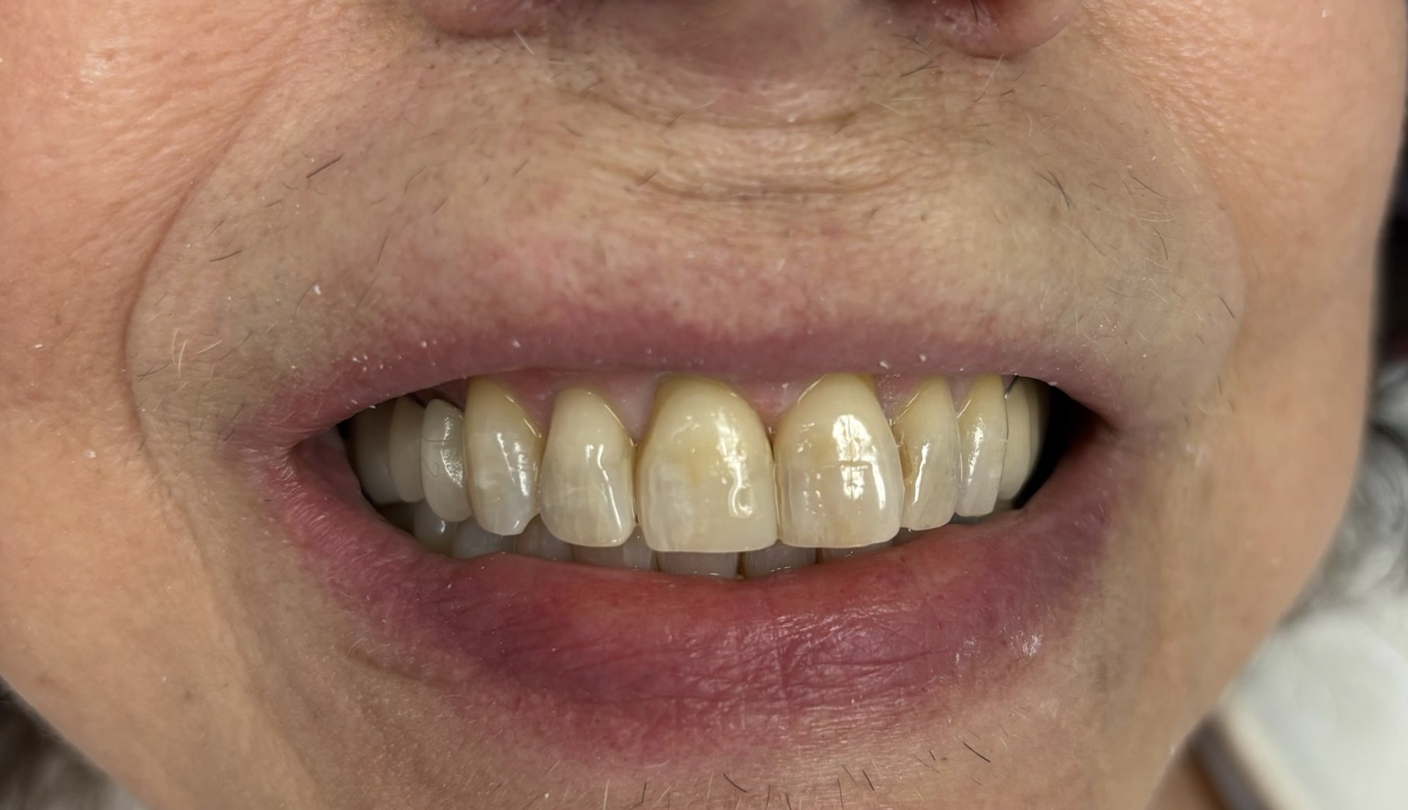 After Dental Fillings in Thousand Oaks