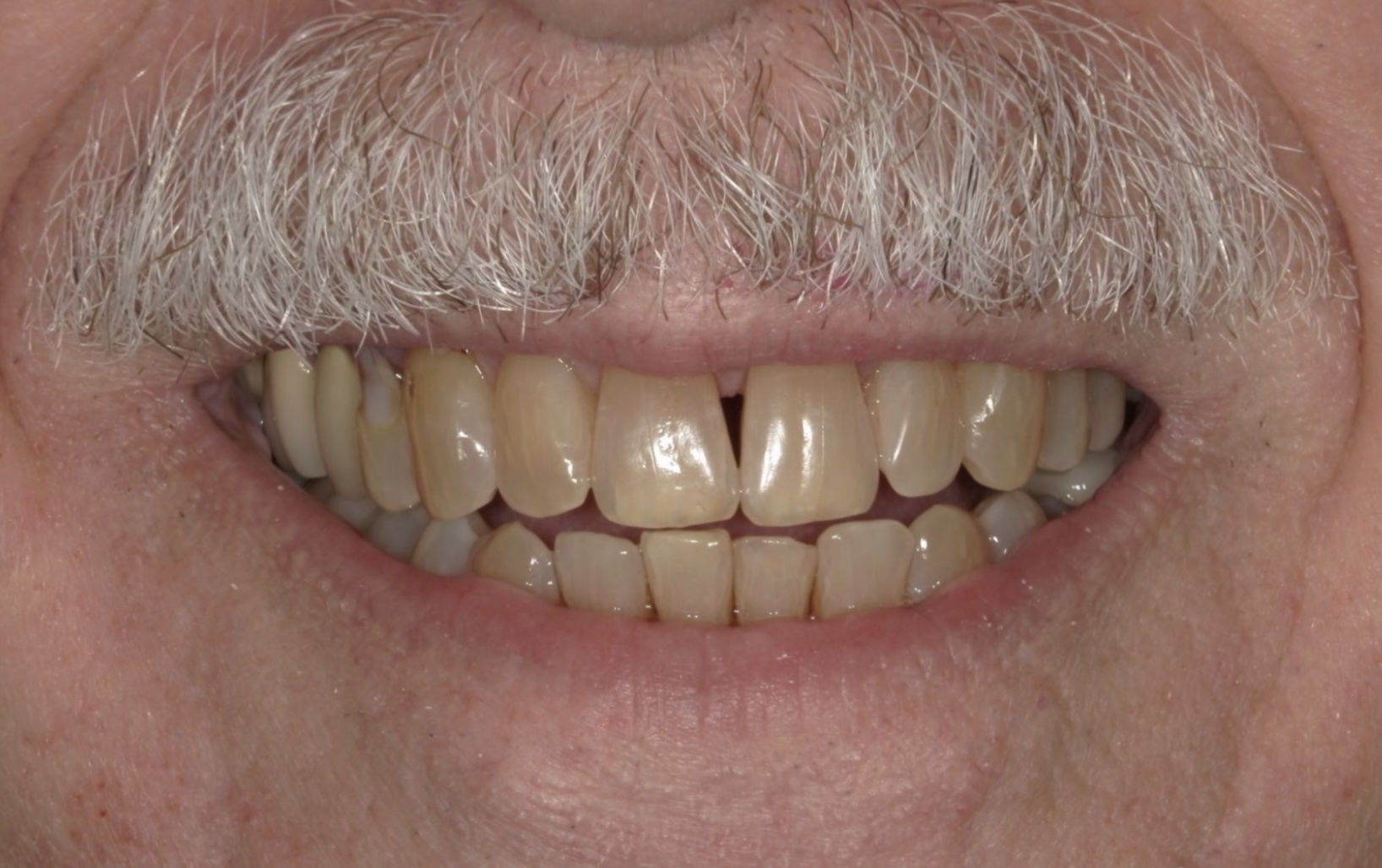 After Orthodontics in Thousand Oaks