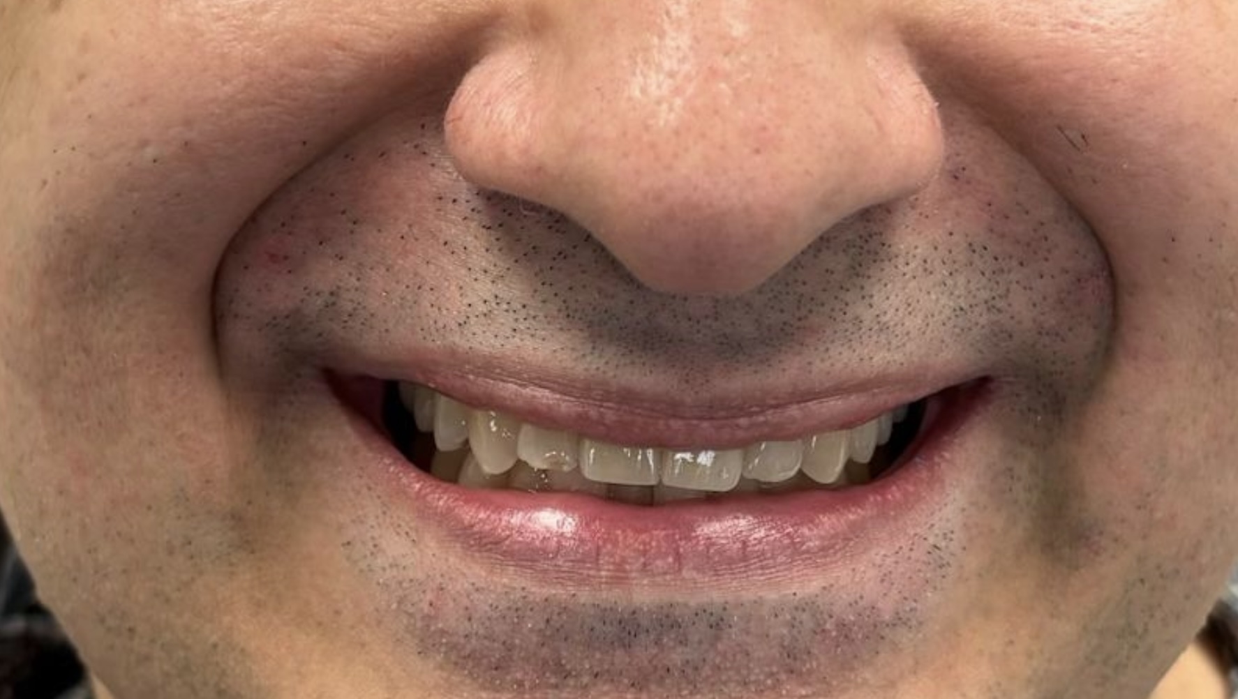 After Dental Crowns in Thousand Oaks