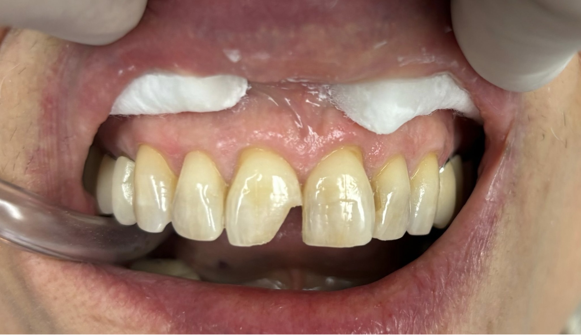 Before Dental Fillings in Thousand Oaks