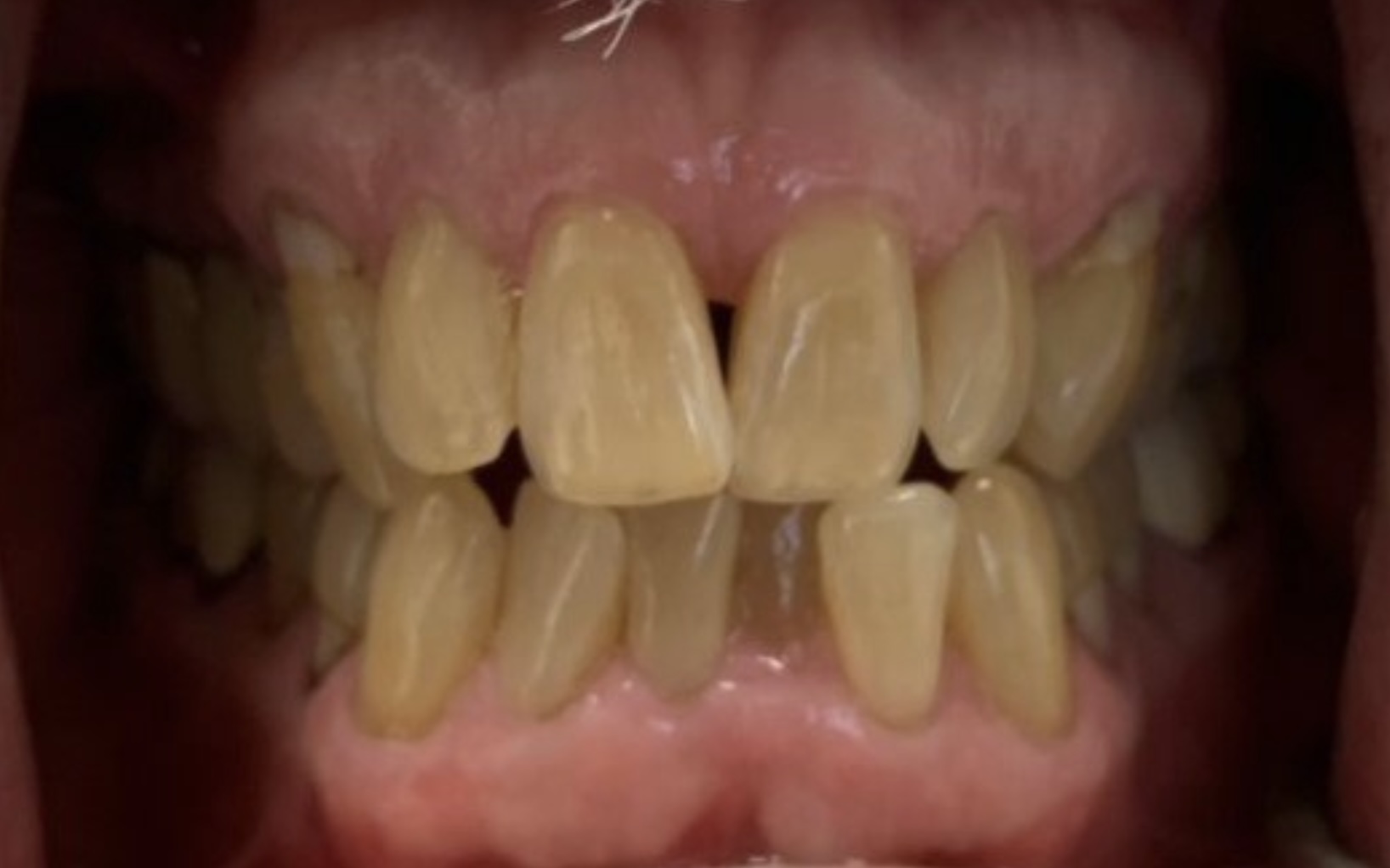 Before Orthodontics in Thousand Oaks