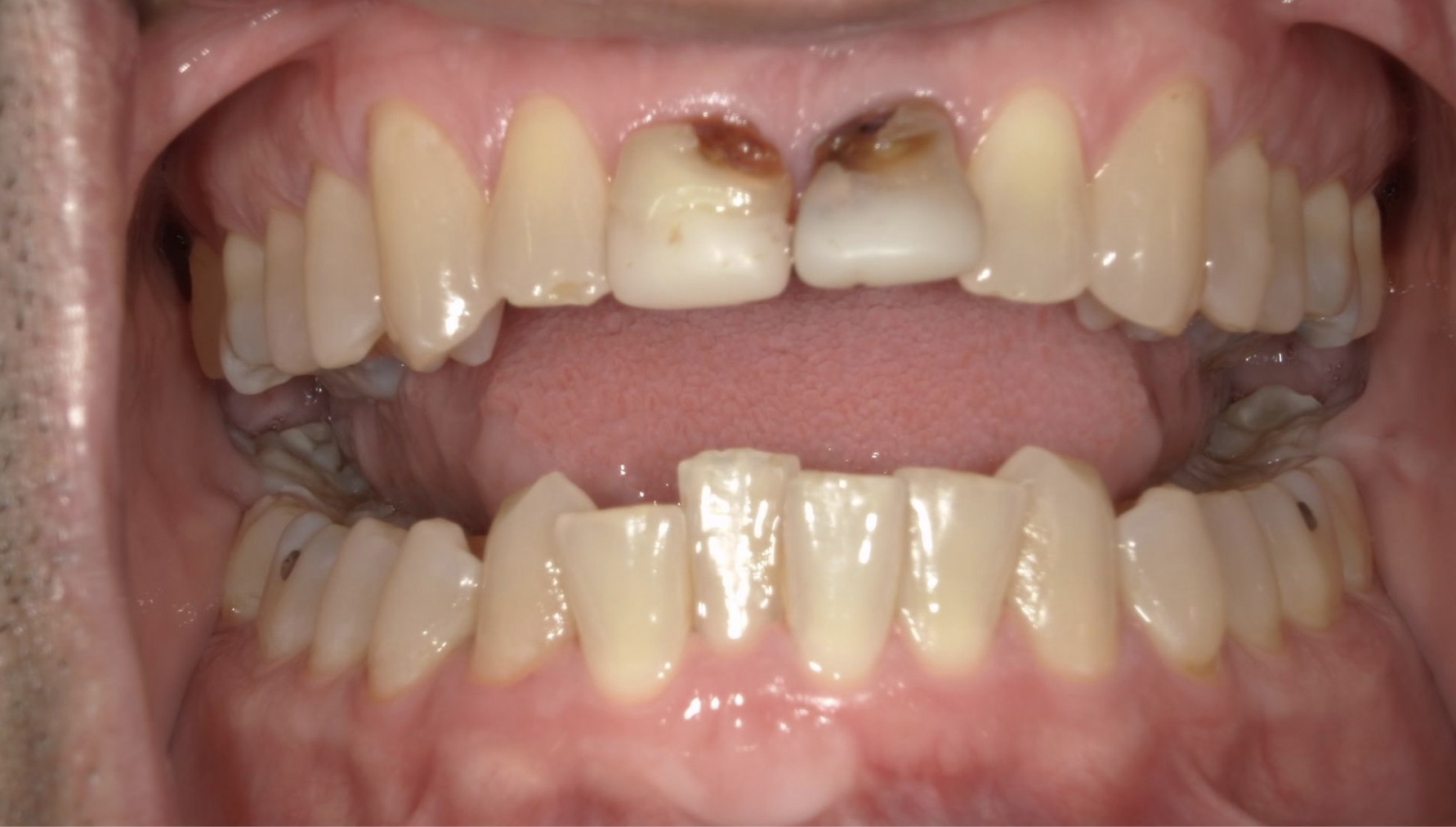 Before Dental Crowns in Thousand Oaks