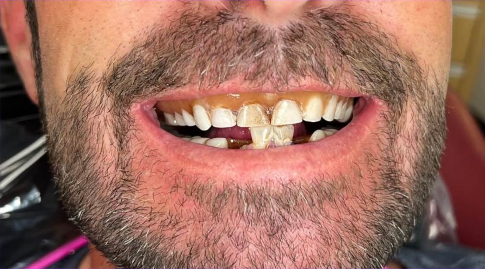 Before Dentures in Thousand Oaks