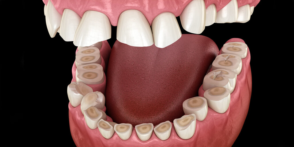 Illustration of bruxism showing teeth grinding and clenching, with worn-down enamel, cracks, and stress on the jaw compared to normal healthy teeth.