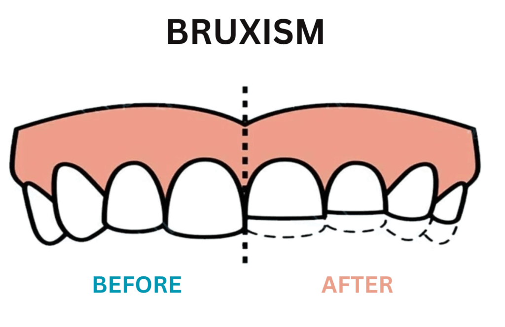 Dental illustration comparing teeth before and after bruxism.